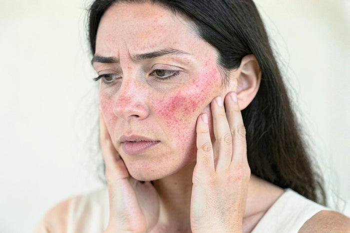 Woman holding her face in her hands with a concerned expression, showing significant redness and inflammation across her cheeks and forehead associated with eczema-prone skin