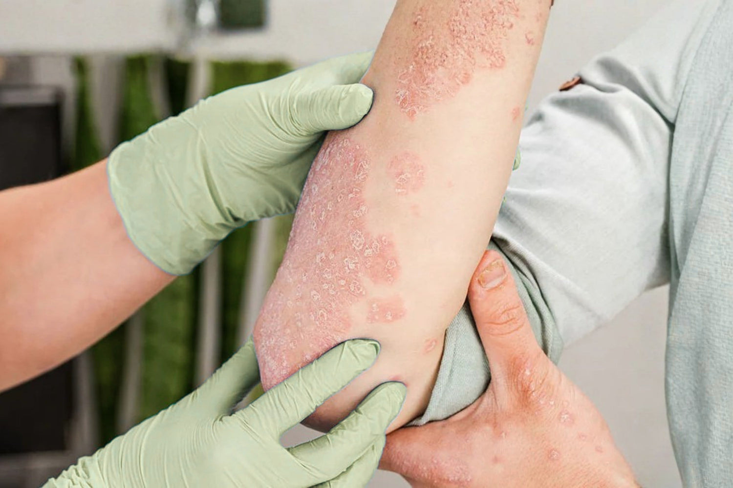 Close-up of a person's arm showing significant eczema inflammation, dry scaly patches and redness during a flare, being examined by a gloved practitioner