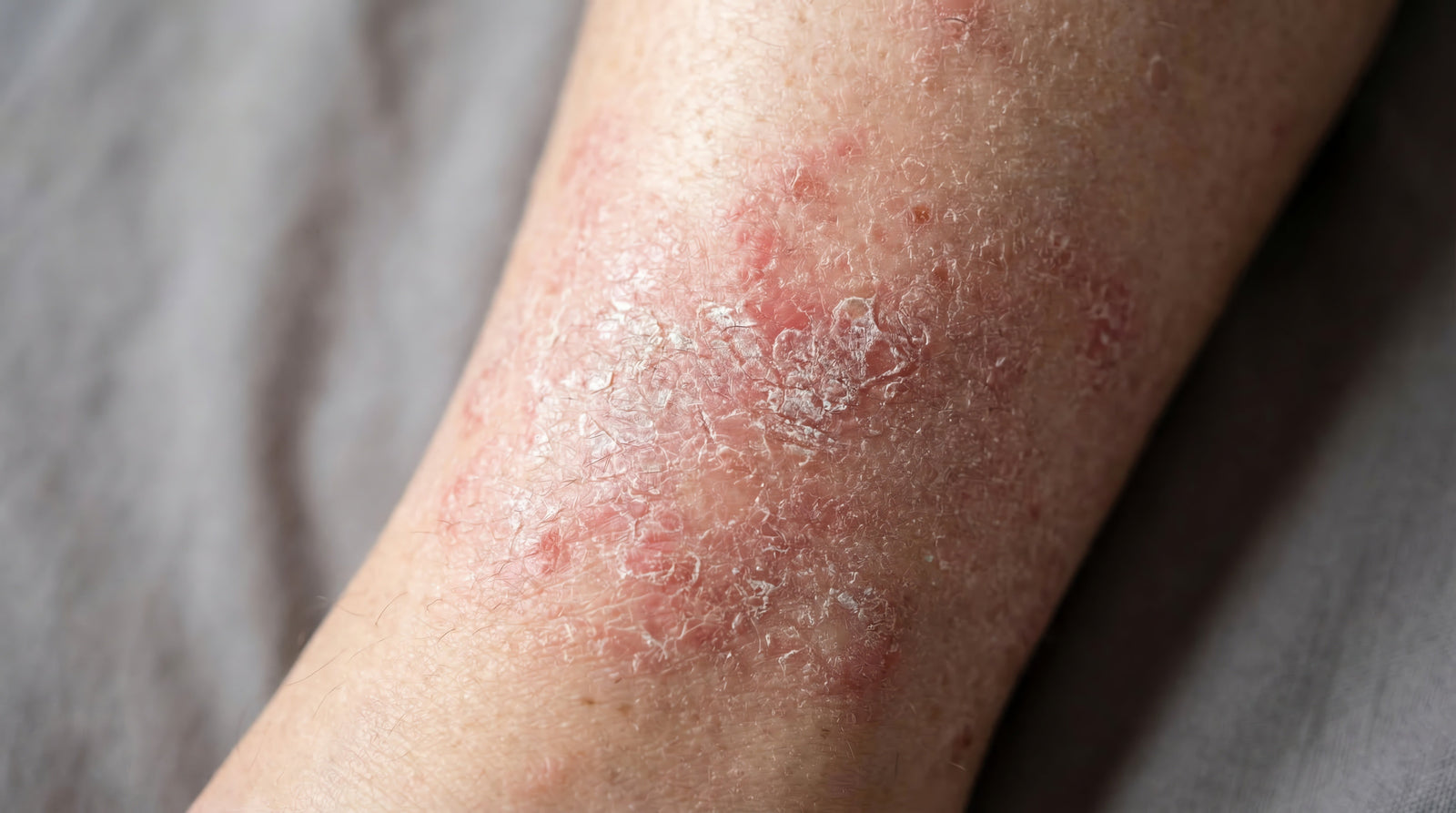What Triggers an Eczema Flare Up & How to Stop It
