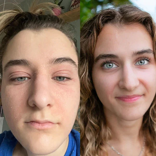 Scarlett's skin transformation